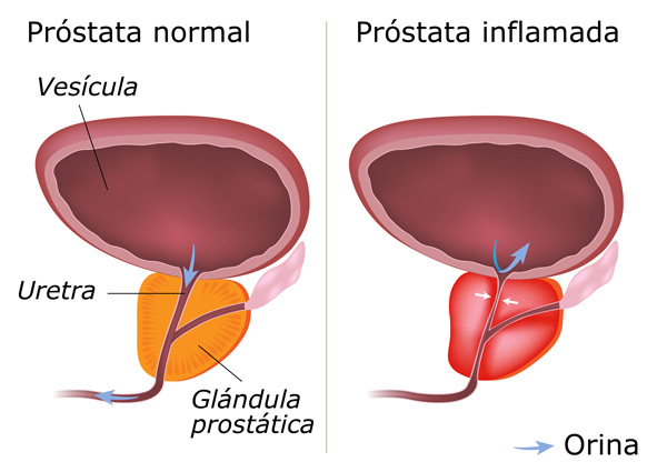 Tipos de prostatitis