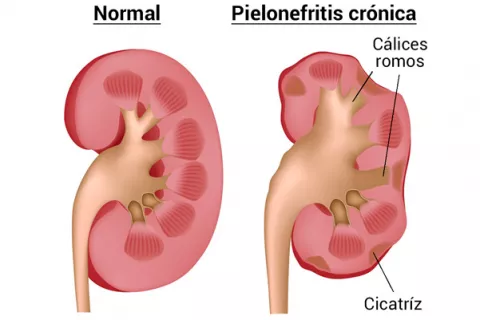 Pronóstico pielonefritis Dos riñones, uno de ellos con signos de pielonefritis