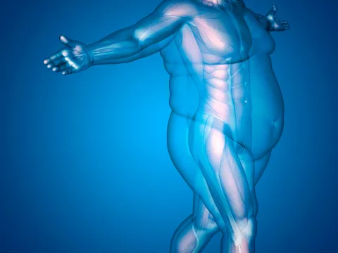 Síntomas de la obesidad Síntomas de la obesidad mórbida