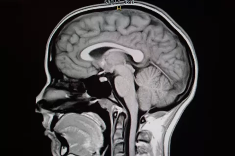Diagnóstico de la neuralgia del trigémino Diagnóstico de la neuralgia del trigémino