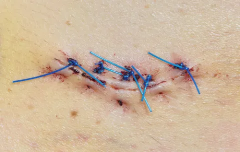 Tratamiento del melanoma Tratamiento quirúrgico del melanoma