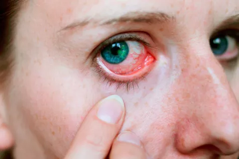 Abrasión corneal Ojos con abrasión corneal