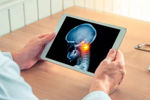'Nuevo estándar de oro' en radioterapia del cáncer de cabeza y cuello Doctor observando en la 'tablet' una infografía de un cáncer en el cuello