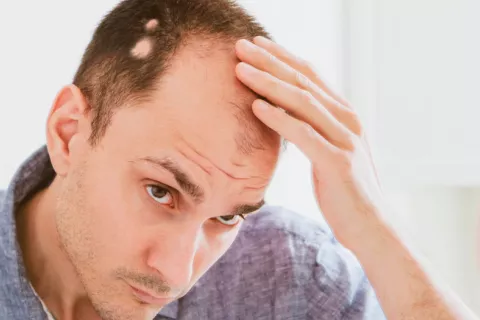 Nuevo tratamiento podría revertir la caída del cabello por alopecia areata Hombre joven observa en el espejo zonas sin cabello en su cabeza