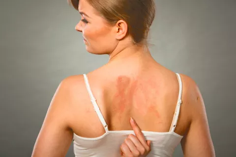 Alergia al sol Signos de la alergia al sol